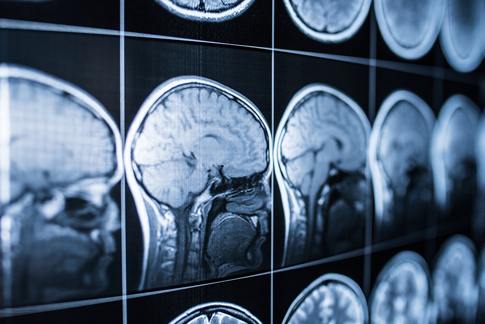 What Causes Most Traumatic Brain Injuries?